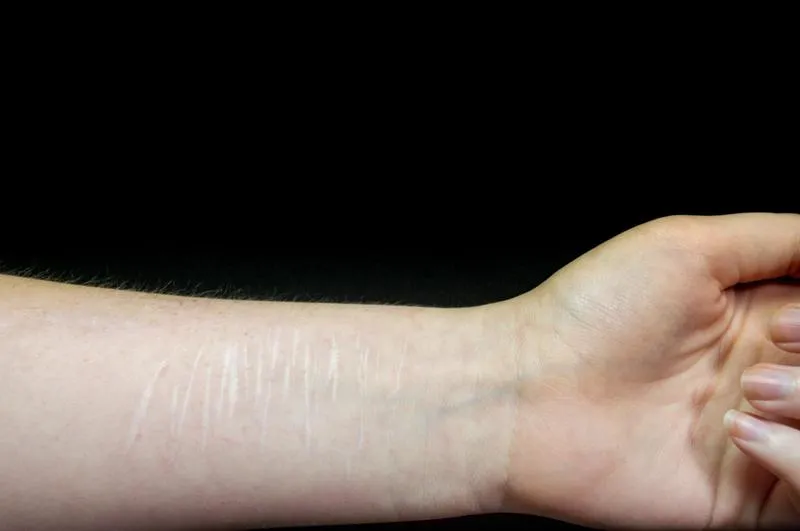 Czy samookaleczanie to grzech ciężki? Zgłębiamy moralne dylematy tej kontrowersyjnej kwestii